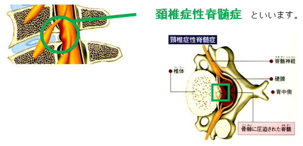 頸椎症性脊髄症